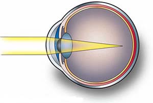 Исцеление близорукости